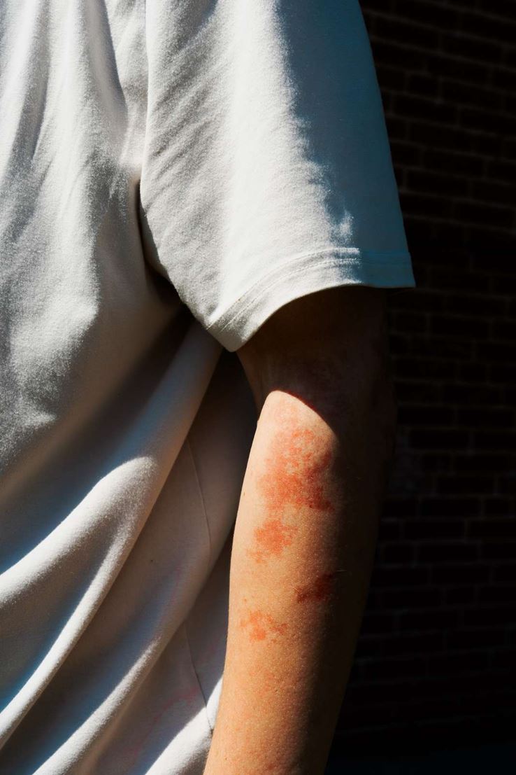 Noels arm har røde pletter, som man kan se, når han er iført T-shirt. 